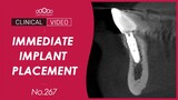 #42 Immediate implant placement after extraction [Dr. Jeon Inseong]