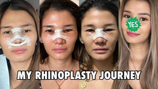 MY RHINOPLASTY JOURNEY - Was it worth it? | Jen Barangan