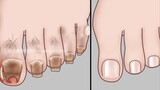ASMR ingrown toenails removal treatment | Animation