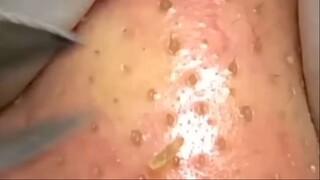 comedones, pimples.Кусачки для выдавливания комедонов применяют тут.