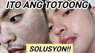 TOTOONG SOLUSYON SA PEKAS SA MUKHA! (Dark Spots, Melasma, etc.)