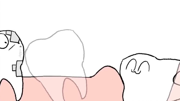 Wisdom tooth animation Who knows the feeling of growing wisdom teeth