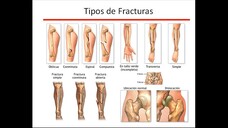 tipos de fractura