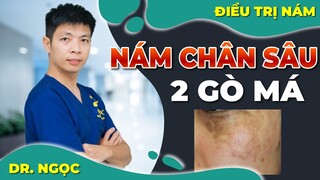 Cách trị nám chân sâu hai bên gò má  - Dr Ngọc