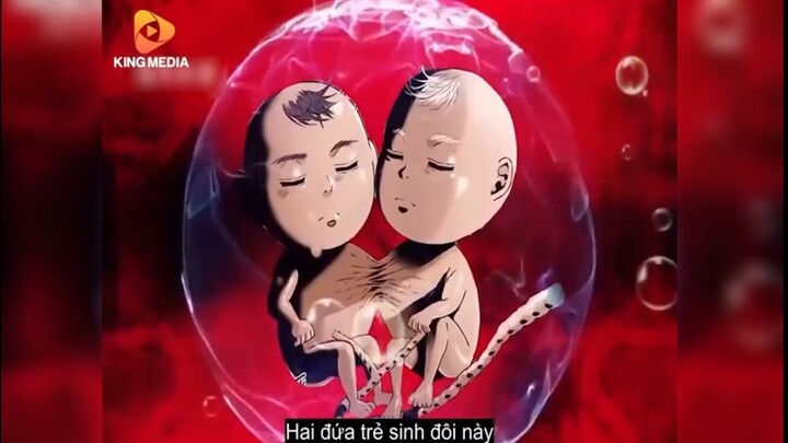 Hai Anh Em Sinh Đôi Dính Liền Cơ Thể Tính Tình Tàn Ác Diệt Cả Gia Đình