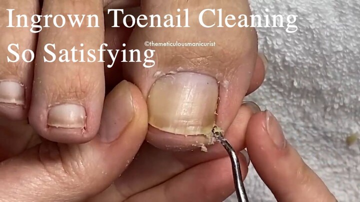 Mr. Meticulous Deep Sidewall Cleaning Ingrown Prevention