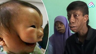 SERING DI BULLY KARENA ALAMI KELAINAN GENETIK! 10 Manusia Dengan Kondisi Super Langka Sejak Lahir