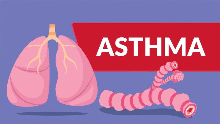 Asthma