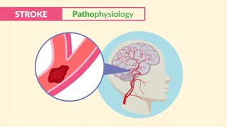 Stroke CVA