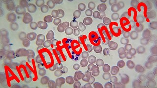 Blood Cells Before And After Covid19 Vaccine And Infection