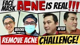 [INT'L SUB] REMOVE ACNE CHALLENGE l FACE MASK ACNE IS REAL l PIMPLES BREAKOUT l FACIAL SKINCARE TIPS