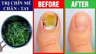 TRỊ DỨT ĐIỂM CHÍN MÉ CHÂN TAY BẰNG PHƯƠNG PHÁP TỰ NHIÊN