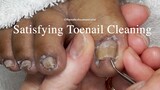 Prevent Ingrown Toenails on all the Toes