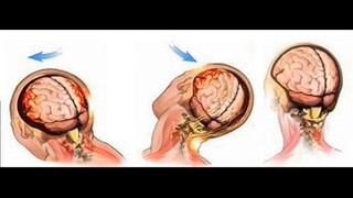 Patología craneocerebral