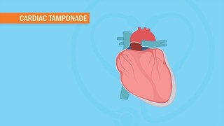 Cardiac Tamponade