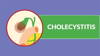 Cholecystitis