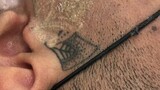 Menghapus tatto dengan laser