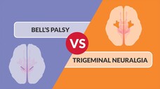 Bell's Palsy vs. Trigeminal Neuralgia