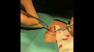 3-Step Cyst Removal Process Demonstration - Minimal Scarring Technique