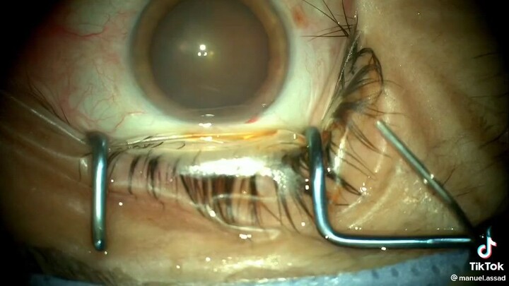 Eyes operation