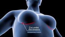 How breast enlargement surgery is carried out