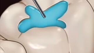 ASMR | Too much sweet can cause cavity | Cavity Removal..