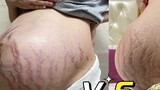 [Postpartum Diary] The cost of giving birth to stretch marks (continuously updated)