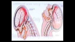 Patologías cerebrales causadas por golpes