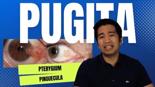 PAANO MAPAPAWALA ANG PUGITA? (PTERYGIUM/PINGUECULA)