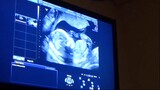 LIVE ULTRASOUND! - PREGNANCY UPDATE
