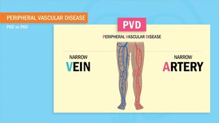 Peripheral Vascular Disease Vs. Peripheral Artery Disease (PVD vs. PAD)