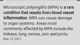 Microscopic Polyangiitis Penyakit yang merusak pembuluh darah Dan itu sebabnya itachi batukðŸ—¿ðŸ‘�