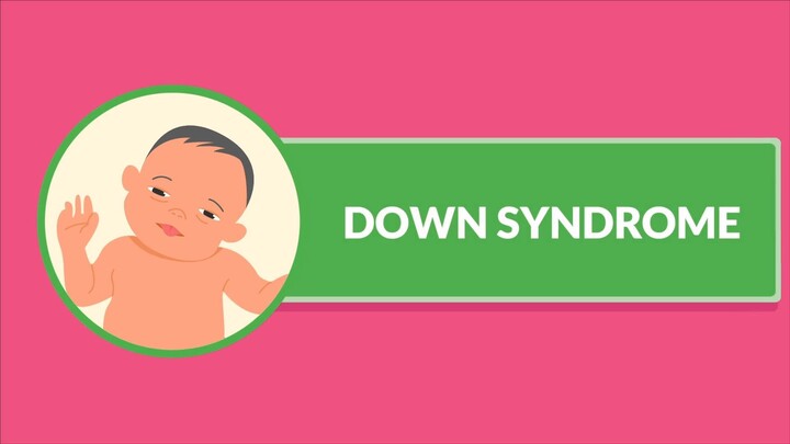 Down Syndrome