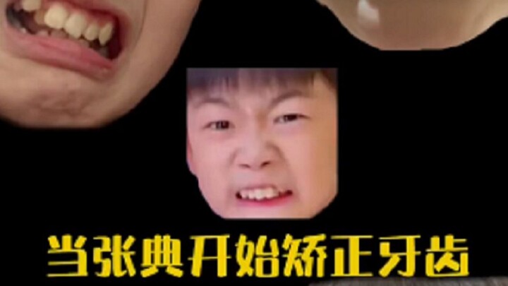 张典矫正牙齿的心路历程#晨晨典典