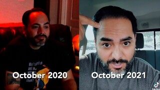 Hair Transplant Update ...5 Months Later