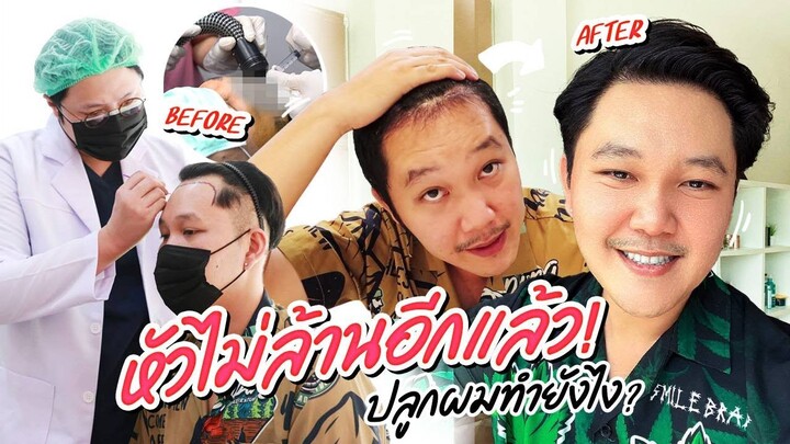 ปลูกผมครั้งแรก! ใครอยากปลูกต้องดู รีวิวละเอียดทุกขั้นตอน | BB Memory