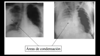 Sindrome de condensación pulmonar