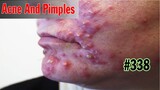 Acne And Pimples | Mụn Ẩn, Mụn Viêm - SacDepSpa#338