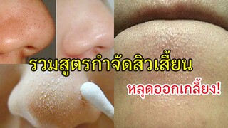 ลองเลย !! รวมสูตรกำจัดสิวเสี้ยน' หลุดออกเกลี้ยง ไม่ขึ้นมาให้น่ารำคาญอีกต่อไป!!!