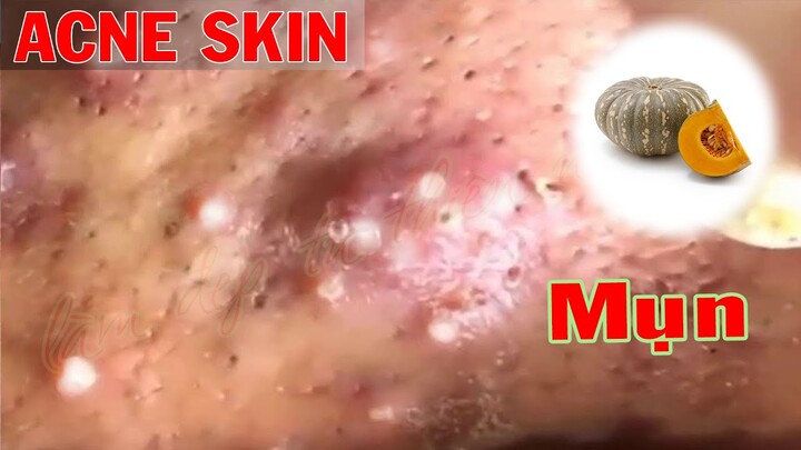 Acne P1 | Trị Mụn Nám Da - SacDepSp #357 | Làm Đẹp Từ Thiên Nhiên #38