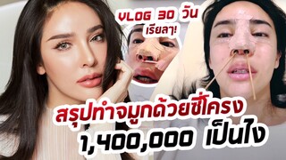 บทสรุปชีวิตหลังเสริมจมูกด้วยซี่โครง 1,400,000 บาท เป็นยังไง!!! | Nisamanee.Nutt