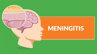 Meningitis