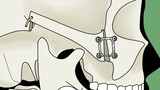 Double chin + bone grinding surgery