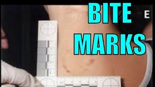 Delphi Murders: BITE marks.