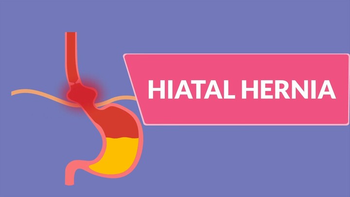 Hiatal Hernia