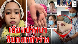 เด็ก 7 ขวบเลือดไหลออกตัวปริศนา สื่อรุดดูซึมทะลักออกมือ หมอแจงเกิดขึ้นยากมาก | ทุบโต๊ะข่าว | 13/04/65