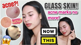 PAANO NAWALA ANG ACNE MARKS KO? SKIN BLISS REJUVENATING SET FOR GLASS SKIN