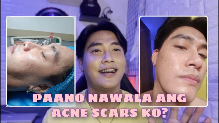 PAANO NAWALA ANG ACNE SCARS KO?