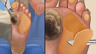 Extremely comfortable! The whole process of pedicure for super thick calluses [unzipping animation]