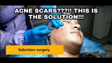 HOW TO REMOVE SCARS EFFECTIVELY (PART 2) SUBSCISION + UPDATE